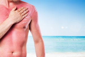 Arsurile solare și mâncărimea pielii: cum să vă tratați